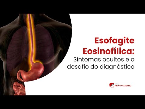Eosinophilic esophagitis: Hidden symptoms and the challenge of diagnosis | Hepatogastro Clinic