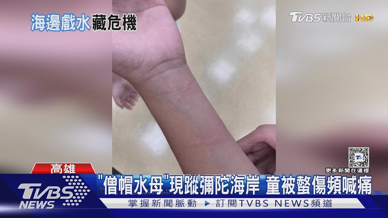 家長注意!劇毒水母現蹤彌陀海岸 至少4童遭螫傷