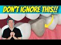 What is a DEAD TOOTH and what to do about it