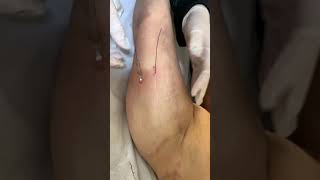 Fios de Tração - CLÍNICA LILIAN FONSECA - Limeira / SP