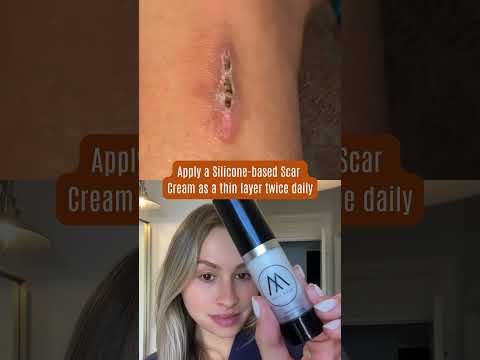 This is How this Silicone- based Scar Cream will HEAL your Scars!