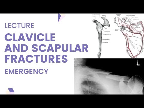 Clavicle and scapular fractures - Causes, Diagnosis and Treatment