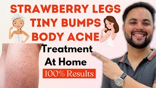 Strawberry Legs ,Tiny Bumps & Body Acne Treatment at Home ||100% Results