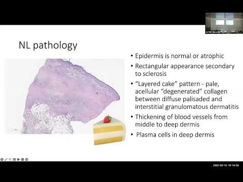 "Necrobiosis- Pathophysiology and Management," Emanual Maverakis, MD, Professor of Dermatology