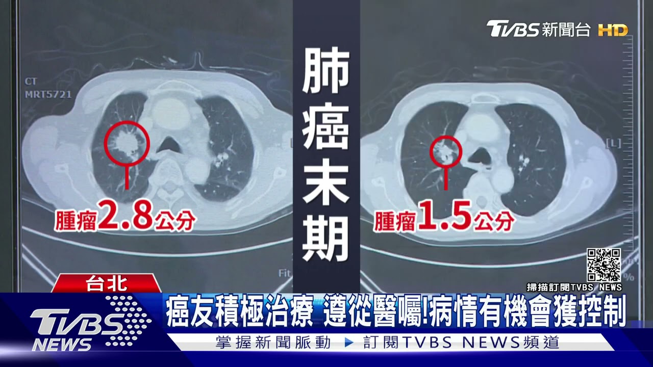 治療癌症!這療法有機會 醫師:提高存活率!