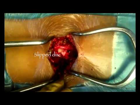 massive slipped disc