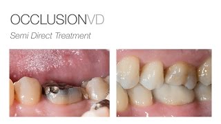 edelweiss OCCLUSIONVD