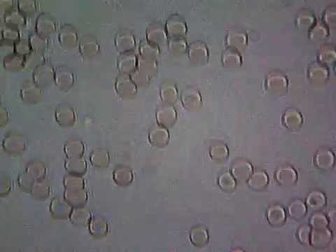 Was ist Prostata-Samen Video Prostata-Brachytherapie