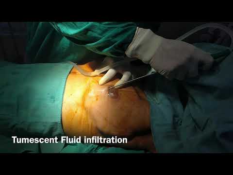 Patient Recovery Case — Video 16 (Liposuction)