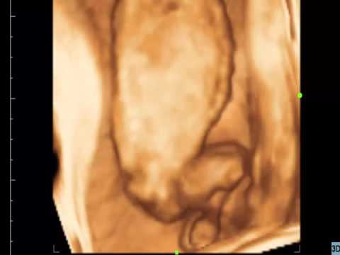 CASE 161 PARIETO OCCIPITAL ENCEPHALOCELE ,MESOMELIC DOWARFISM