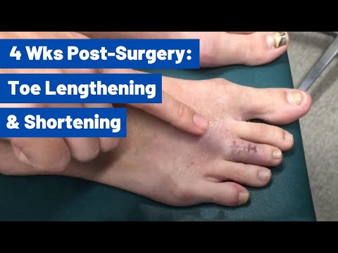 Cosmetic Toe Shortening Long Toe Surgery Video Without Metal Pins