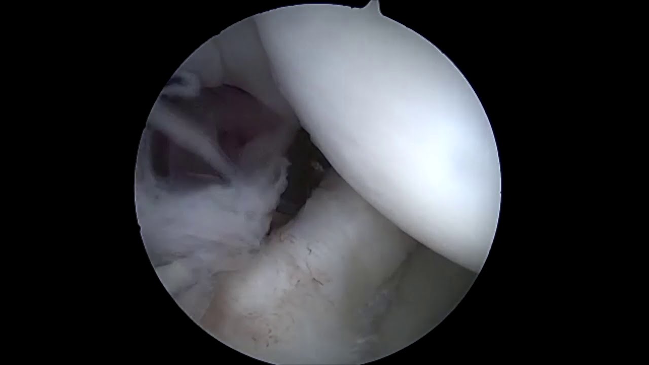 Dr. Garcia demonstrates his arthroscopic surgical technique for anterior labrum “Bankart...