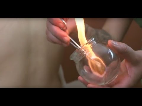 What is Fire Cupping?