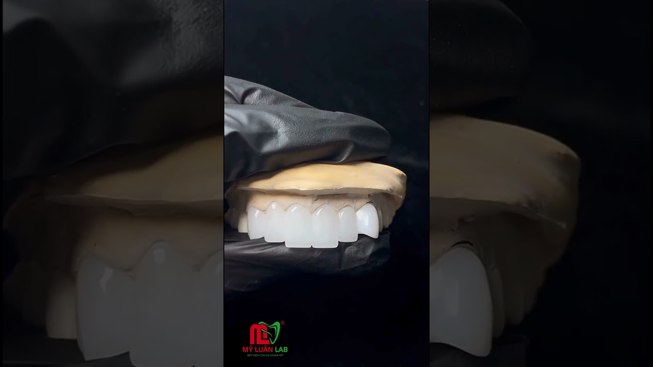 Hoàn Thành Ca Răng Toàn Sứ Kết Hợp Răng Kim Cương Đẹp Tinh Tế