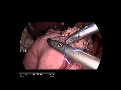 Laparoscopic Pancreaticoduodenectomy And Right Hemicolectomy