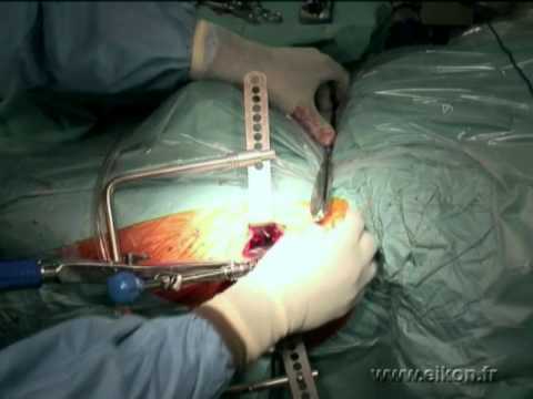 Rückenschmerzen Behandlung mit Schlamm Bewertungen Jährige Arbeit in Osteochondrose