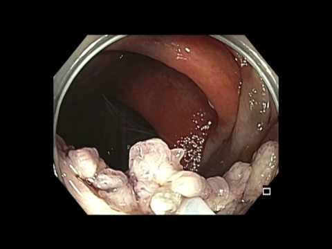 Colonoscopia: resección endoscópica de la mucosa de colon ascendente - caso de 2 horas