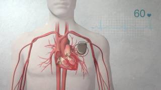 What is a pacemaker