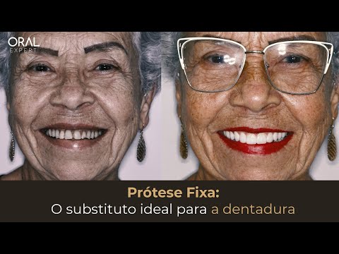 Próteses Fixas em Implantes: Diga Adeus à Instabilidade!