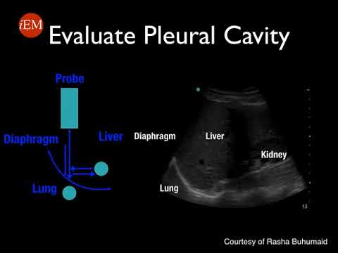 Video 11   Tutorial on lung ultrasound for pleural effusion