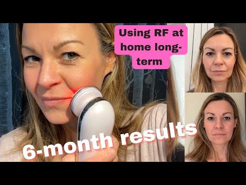 Six-month Lumo radiofrequency results and how to use RF devices cautiously long-term