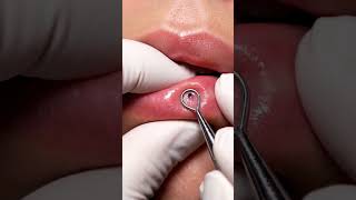 Can You Handle This Satisfying Pimple Pop?