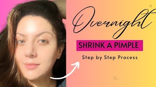 Watch Me Shrink This Pimple Fast! Acne Treatment I Overnight Acne Treatment at Home