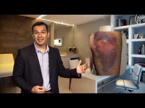 Tipos de lesões musculares e as 3 fases do processo de cicatrização