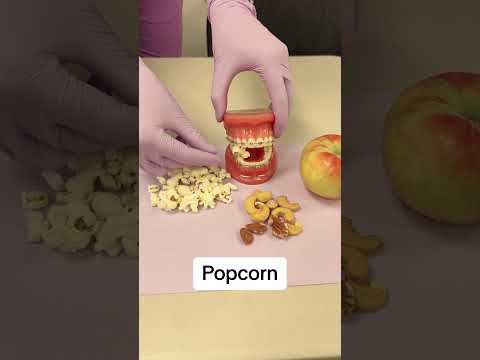 Brace-Friendly Foods: What Not to Eat for a Healthy Smile