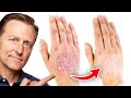 The 1 Best Remedy For Eczema