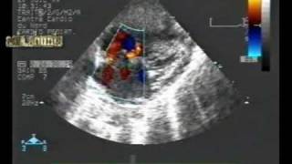 preview picture of video 'atrial septal aneurysm,multiple atrial shunts and vsd.'