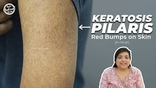 Keratosis Pilaris | Chicken Skin | How to treat Keratosis Pilaris (Hindi) | Dr. Nivedita Dadu