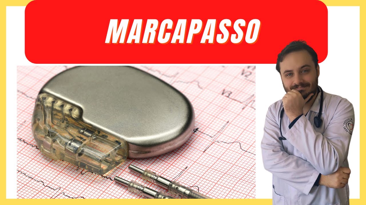 O QUE É MARCAPASSO CARDÍACO COMO É A CIRURGIA (TUDO QUE PRECISA SABER)