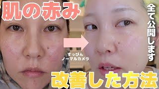 【肌の赤み改善】NG/OKスキンケア、美容医療、塗り薬全て公開します！