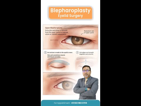 Blepharoplasty Siliguri