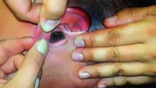Bugs Buried in Girl's Ears!  (Hot!)