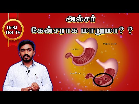 அல்சர் கேன்சராக மாறுமா? Does peptic ulcer cause cancer? in Tamil l DrSj Video