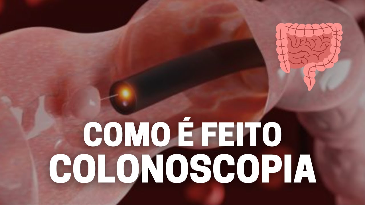 Como é o exame de colonoscopia? [MOSTRANDO TUDO]