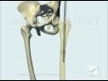 Femoral Fracture Fixation Surgery: Intramedullary Nail