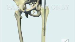 Femoral Fracture Fixation Surgery: Intramedullary 