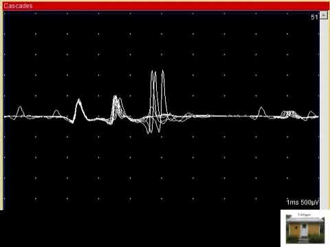 SFEMG - Selecting Trigger Multispike  (Erik Stalberg)