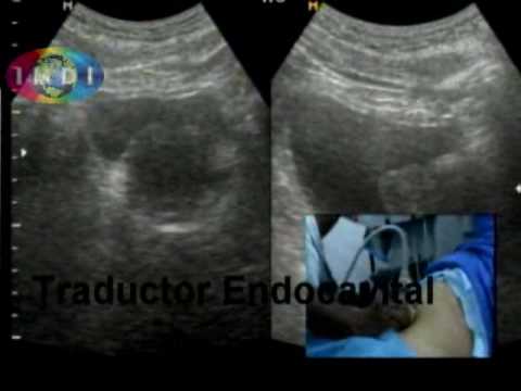 Benign prostatic hyperplasia ultrasound grading