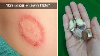 Ringworm Treatment \\ How To Get Rid Of Ringworm In Just 3 Days
