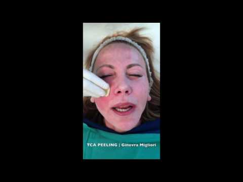 Tsvetotip con lentiggini Le eliminazioni di pigmentary notano in unaquila