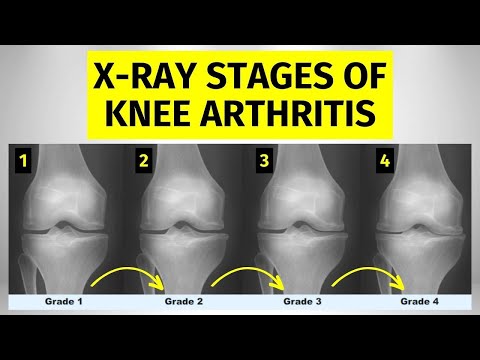 Knee Arthritis X-ray Stages: What You Need To Know