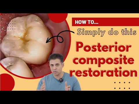 How to Replace An Old Posterior Composite Restoration | Important Hints And Guides For Dentists