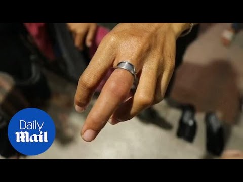 Incredible effort by paramedic to remove ring stuck on finger