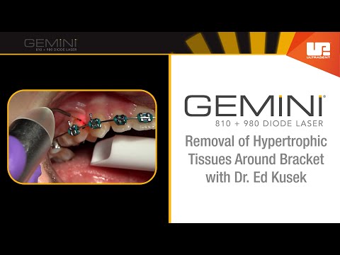 How To Use the Gemini Laser: Hypertrophic Tissue Removal