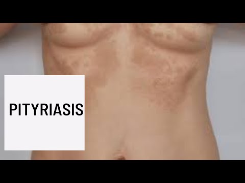 Pityriasis :Causes ,Symptômes et diagnostic,Traitements