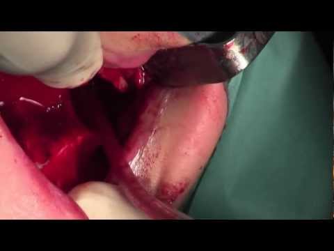 Medicina popolare per il dolore al collo Esercizi di osteocondrosi con vidio